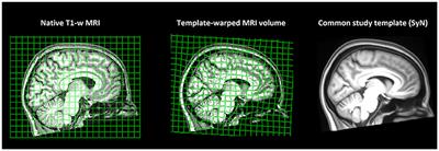 Structural and Functional Reorganization of the Brain in Migraine Without Aura
